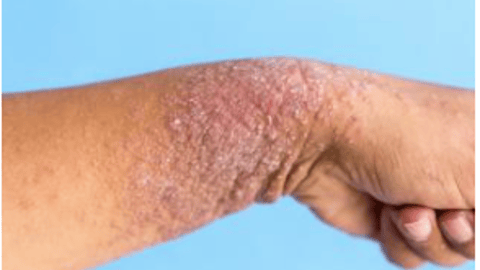 plaque psoriasis