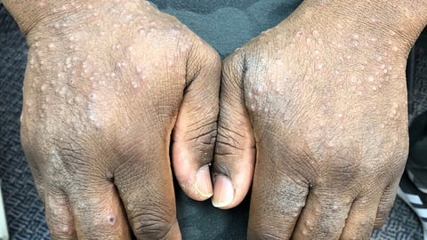 Hand rash