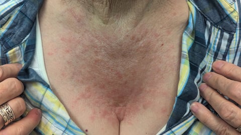 woman with chest rash