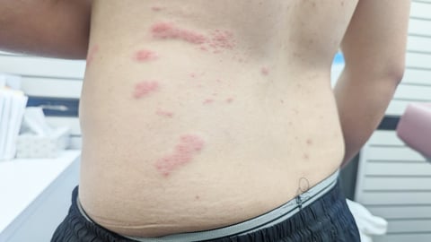 shingles rash