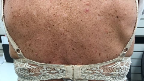 Back rash