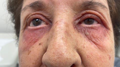 elderly woman with eye rash