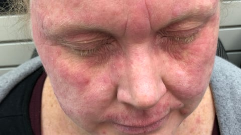 woman with red face rash