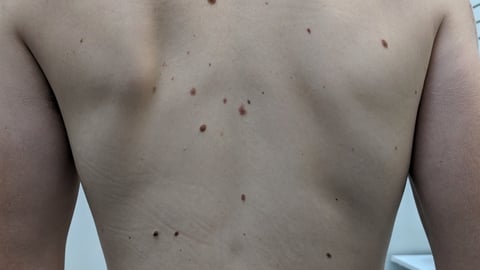 man with back rash