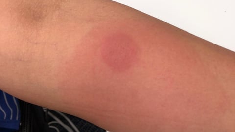 Rash on forearm