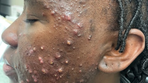 woman with face acne/rash