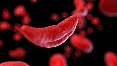 3D rendering of a sickle blood cell