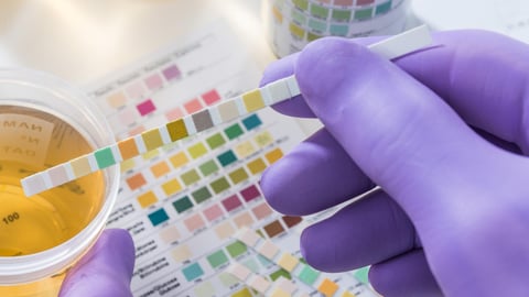 urine test gloved hands dipping test strip in cup of urine to test for bacteria and urinary tract  infection 