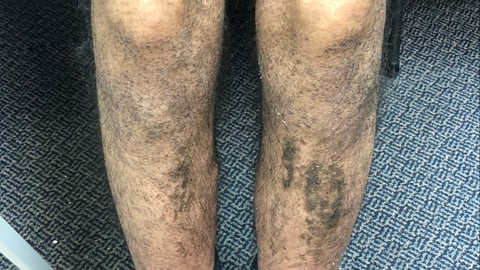 Close up of a patient's legs with a dermatological problem