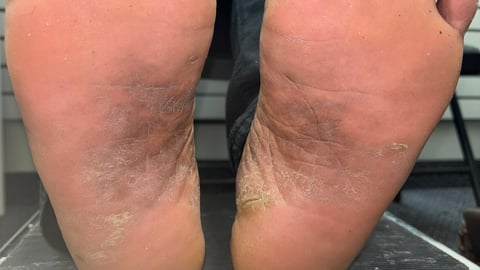 Picture of the bottom of a patients feet from Dr. Robert Dickson's files