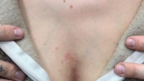 Close up of small rash between breasts of a fair-skinned woman