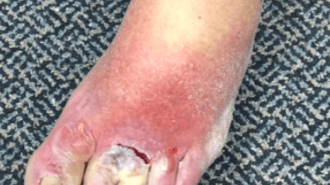 Photo of a foot with a rash and a deep cut near the two middle toes