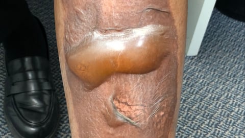 Close up of a patient's badly burned leg