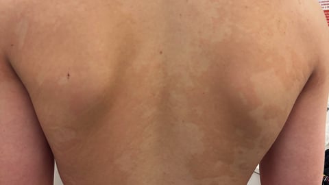Young fair-skinned man's back with a blotchy white rash