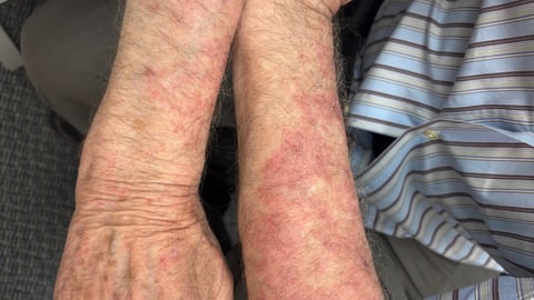 Close up of older white man's arms with red rash