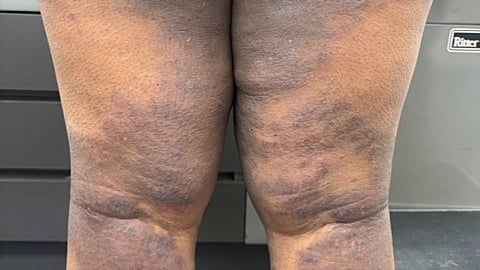 Unusual purple rash on a back of a brown-skinned woman's legs