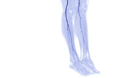 CTA femoral artery run off image of femoral artery for diagnostic Acute or Chronic Peripheral Arterial Disease