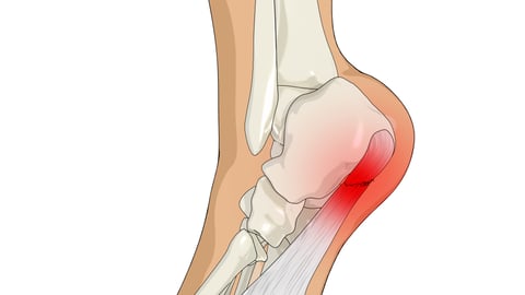 illustration of foot with heel, site of pain, in red