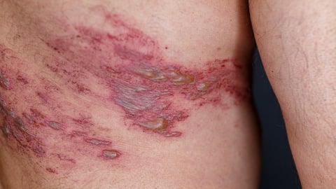 Close up a rash from herpes zoster infection