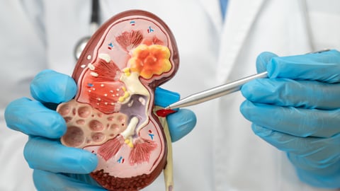 Blue-gloved doctor hands demonstrating a model of a kidney