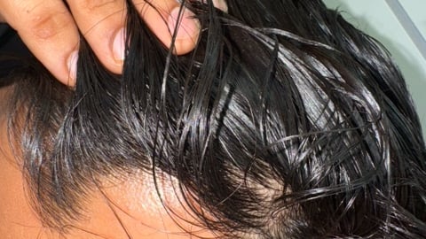 Close up of man showing his scalp through his dark hair