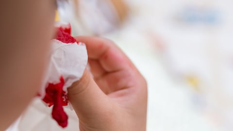 A young child stemming a nosebleed with a tissue