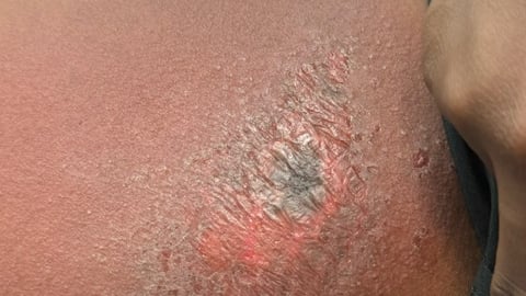 Rash on a dark-skinned child's leg