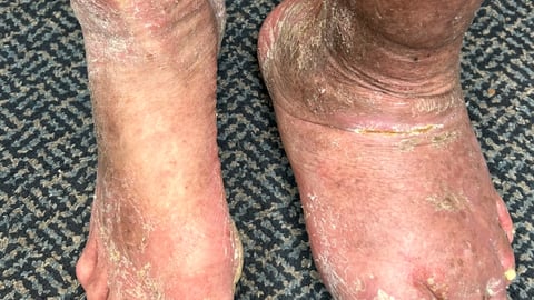 Close up a diabetic's feet
