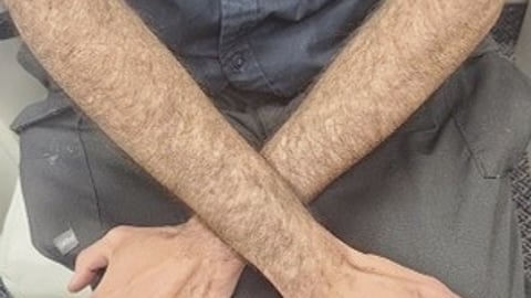 Fair-skinned man with a skin ailment, showing arms to the doctor