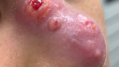 Young person with a grizzly wound on the nose