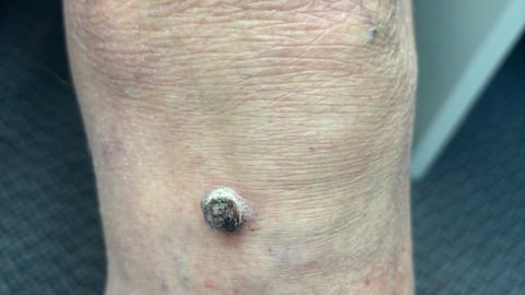 Fair-skinned man's leg with a black boil on it