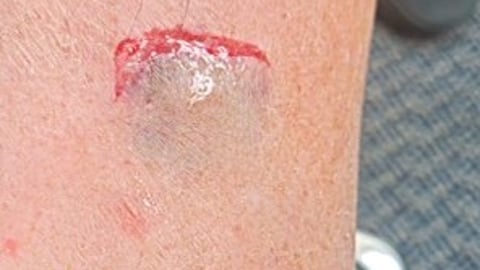 A painful sore on a fair-skinned person's leg