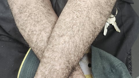 Arms of a patient with an unusual rash