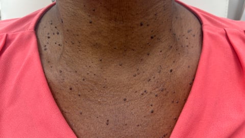 A brown-skinned patient's upper chest