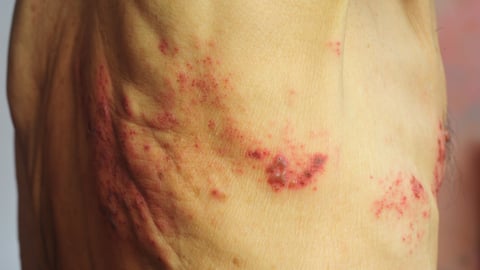 postherpetic neuralgia on the trunk of a fair-skinned male patient