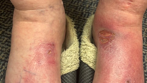 Picture of a patient's sore swollen feet