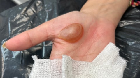Patient's palm with large brown boil on it