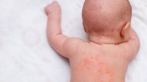 Fair-skinned baby with a red rash on its back