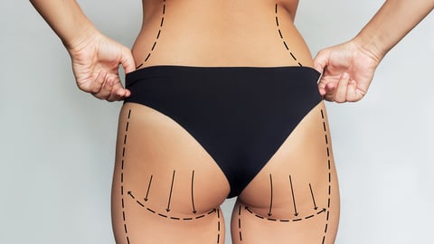 Close up of a woman's glutes with drawings from a plastic surgeon outlining the surgery plan