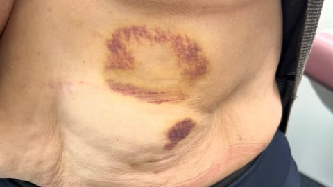 Patient showing a significant bruise on their torso to the doctor