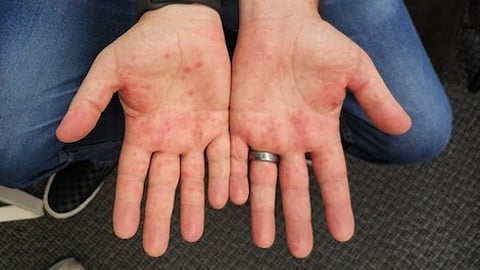 A patients' two palms with a red dusting of sores