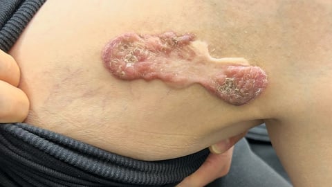 An unusual scar on the fair-skinned leg of a patient