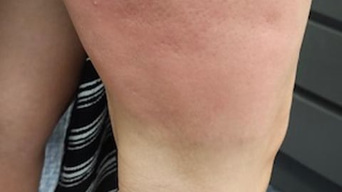 Woman's leg with a large out of control mosquito bite