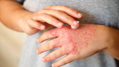 patient applies cream to inflamed hand