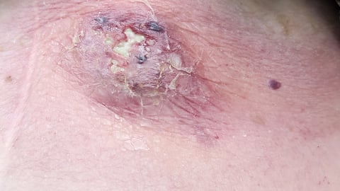 A large blister on a patient's trunk