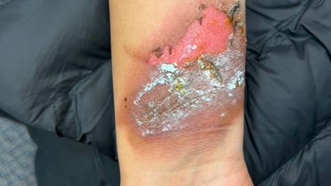 Rash on fair-skinned young patient's arm