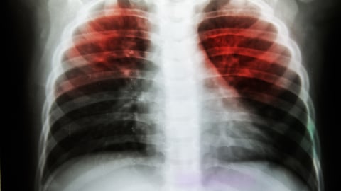 Scan of lungs showing Pulmonary Tuberculosis