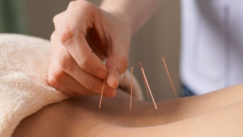Patient receiving acupuncture treatment