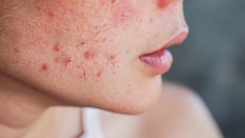 Lower half of a young woman's face with active acne