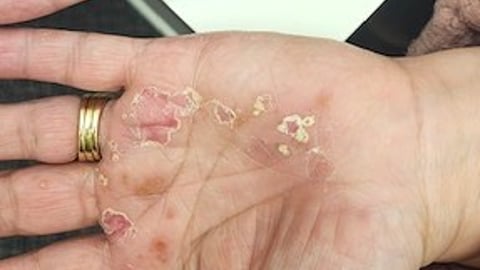 Shot of a patient's hands with a rash